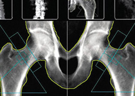 Exame densitometria ossea Richet